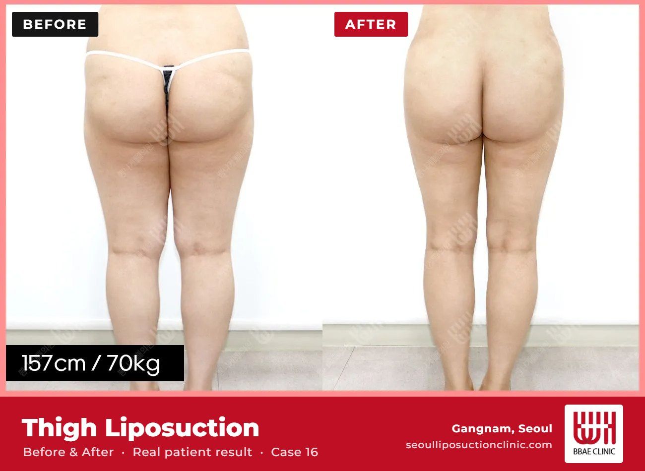 Thigh liposuction before and after, case 16 (photo 1 of 2) – BBAE Clinic, Gangnam Seoul