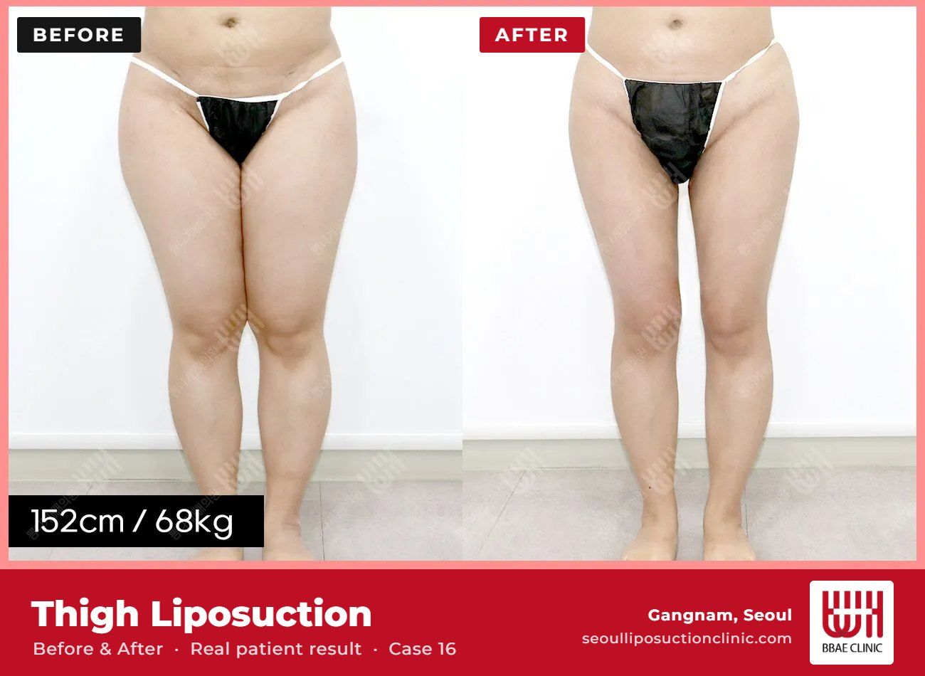 Thigh liposuction before and after, case 16 (photo 2 of 2) – BBAE Clinic, Gangnam Seoul