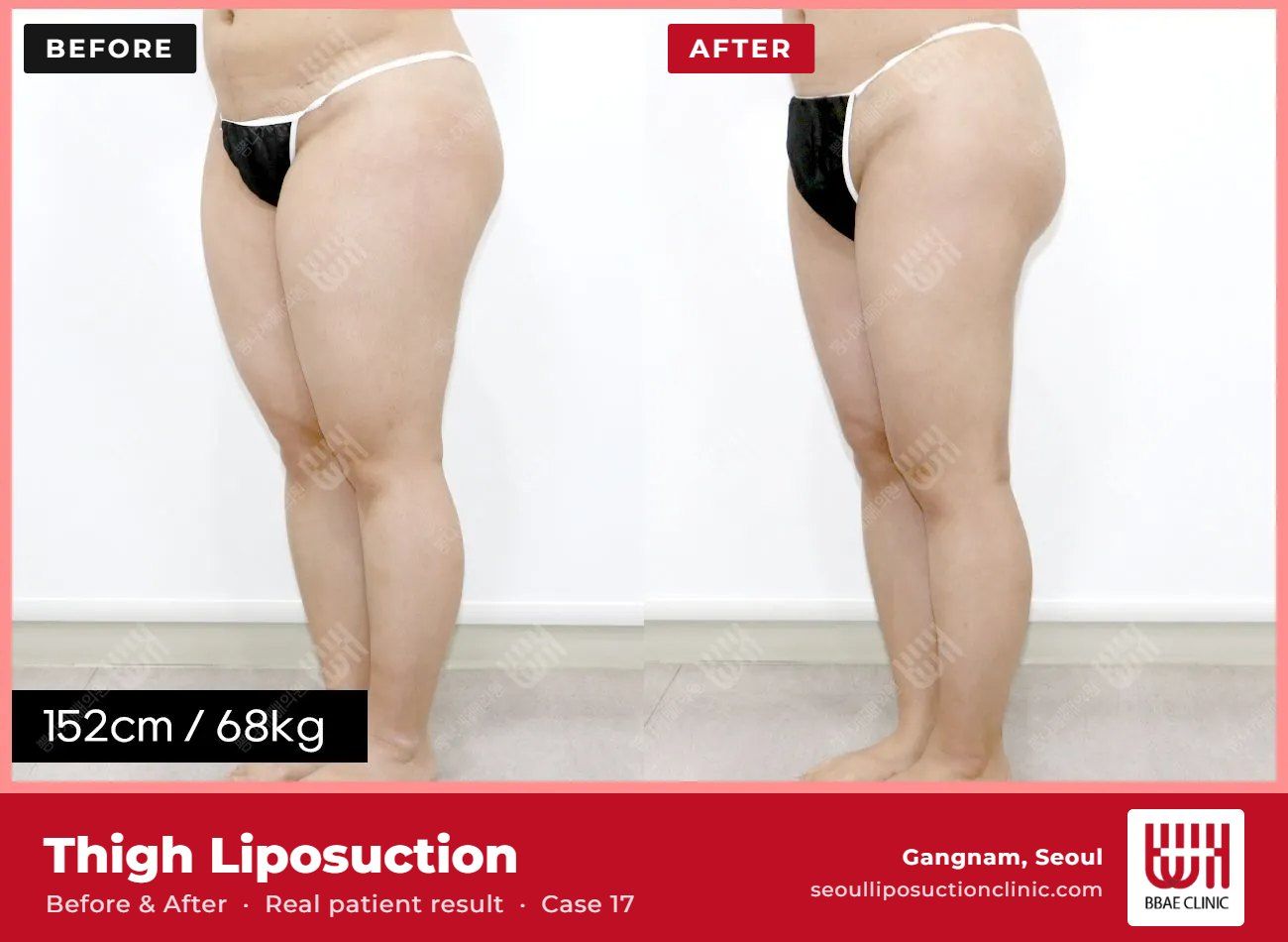 Thigh liposuction before and after, case 17 (photo 1 of 2) – BBAE Clinic, Gangnam Seoul