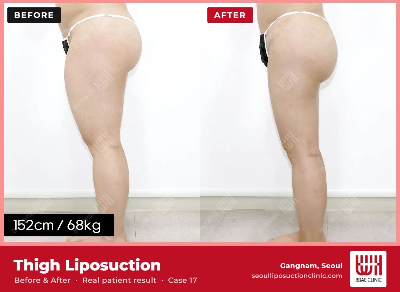 Thigh liposuction before and after, case 17 (photo 2 of 2) – BBAE Clinic, Gangnam Seoul