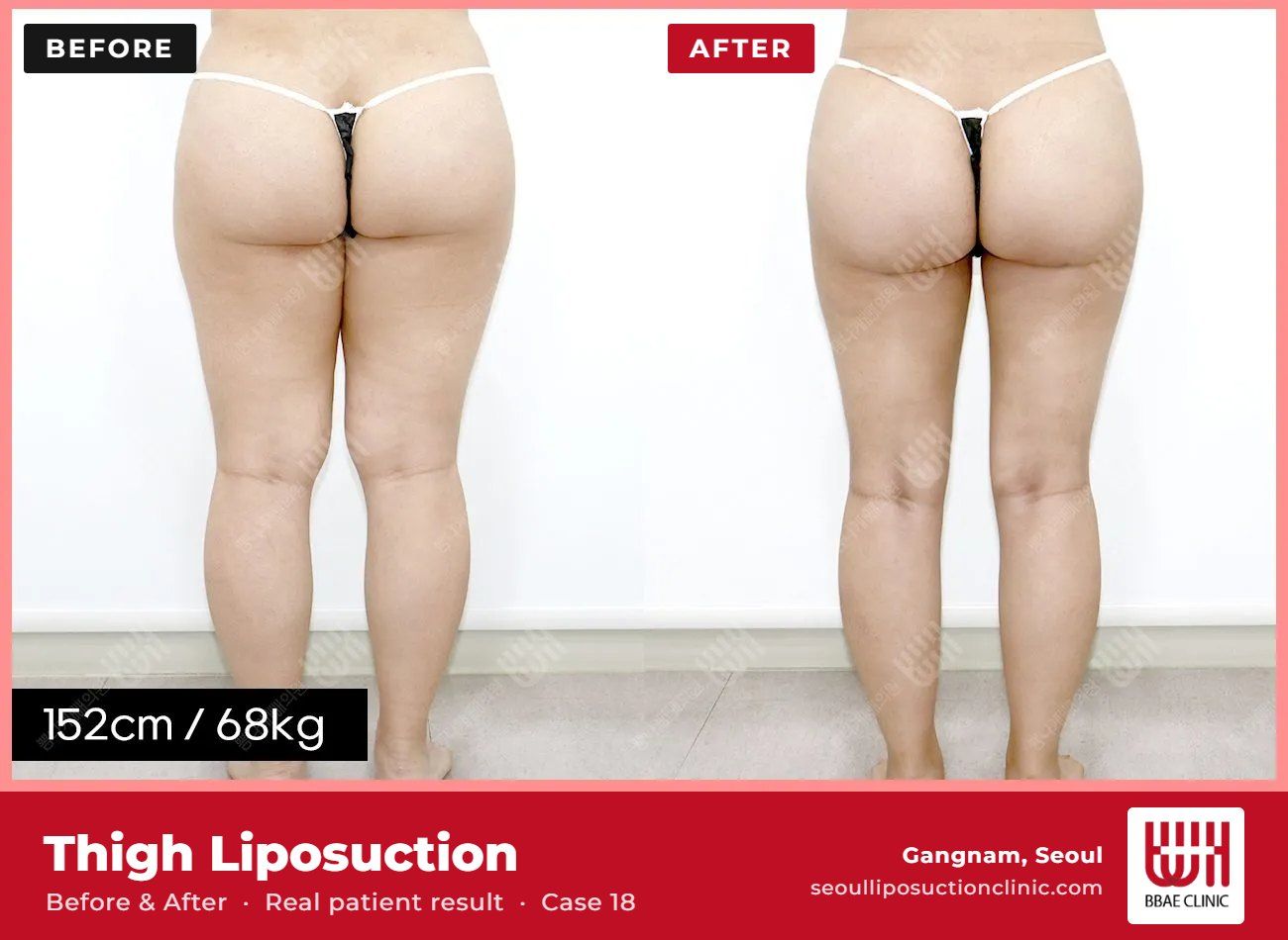 Thigh liposuction before and after, case 18 (photo 1 of 2) – BBAE Clinic, Gangnam Seoul