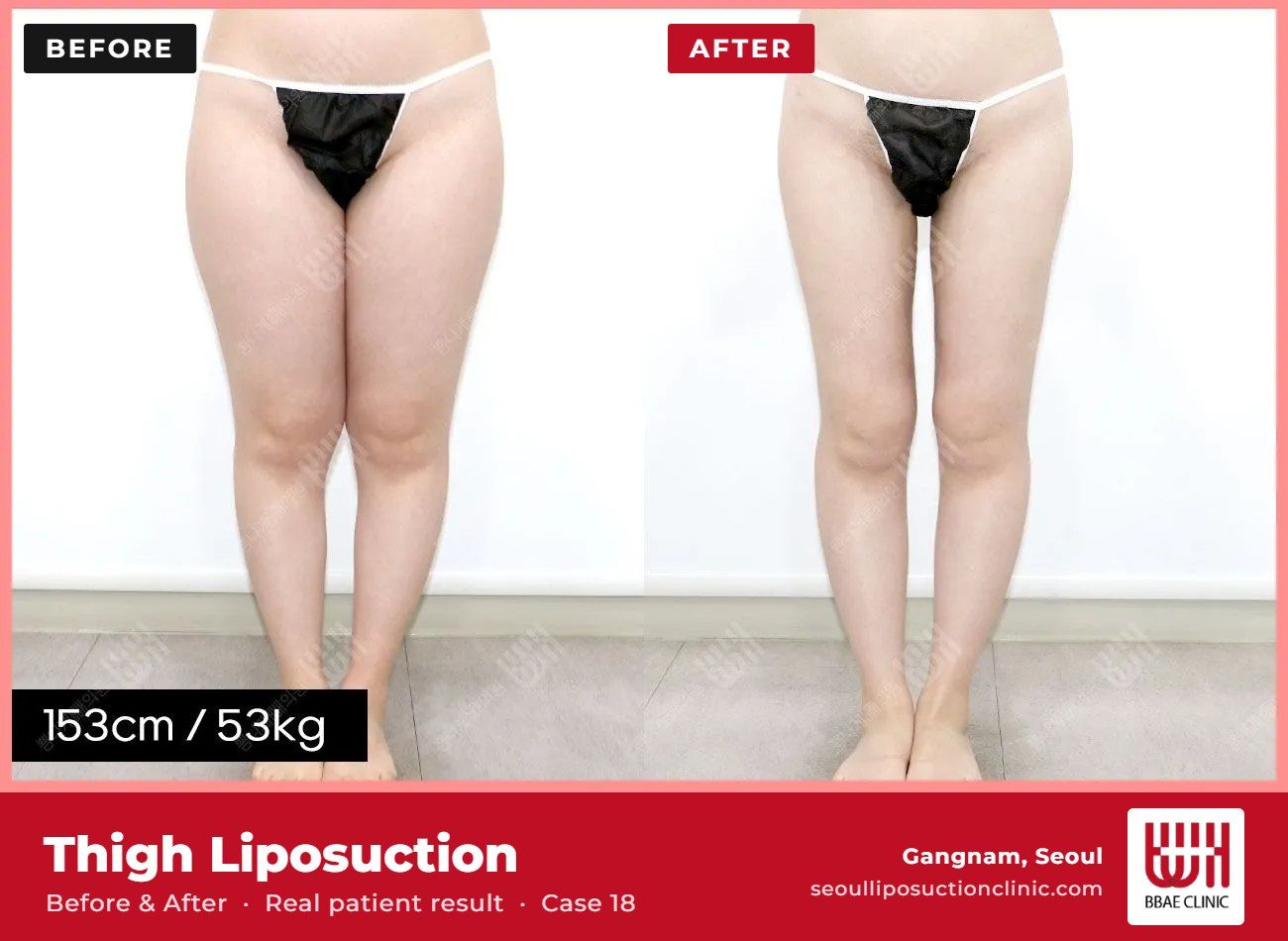 Thigh liposuction before and after, case 18 (photo 2 of 2) – BBAE Clinic, Gangnam Seoul