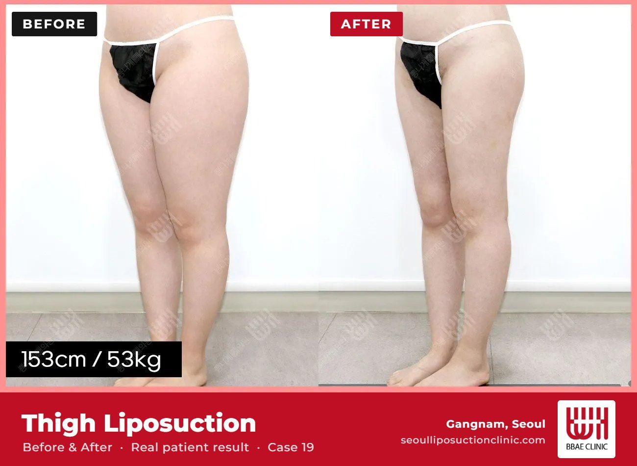 Thigh liposuction before and after, case 19 (photo 1 of 2) – BBAE Clinic, Gangnam Seoul