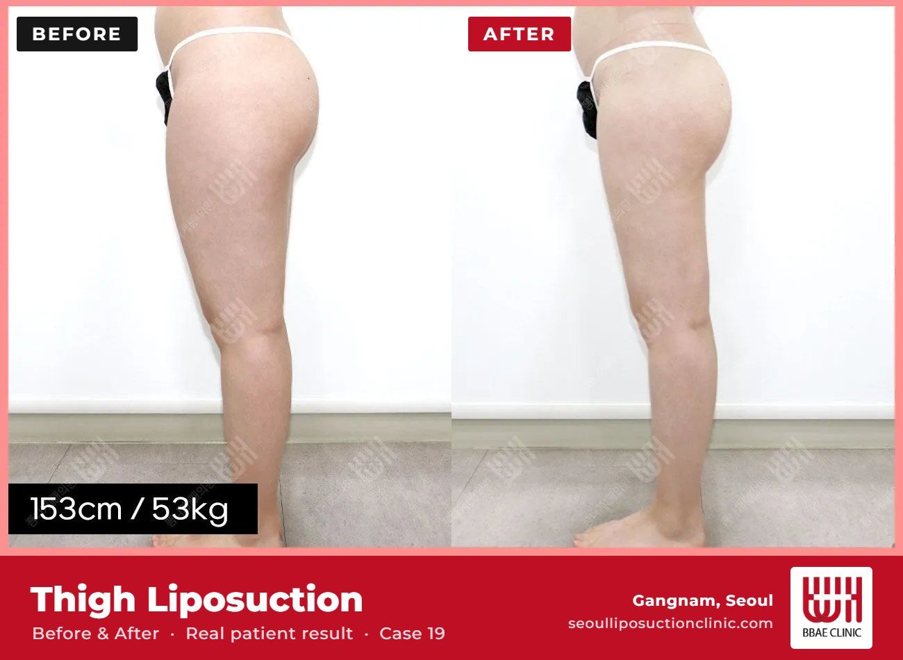 Thigh liposuction before and after, case 19 (photo 2 of 2) – BBAE Clinic, Gangnam Seoul