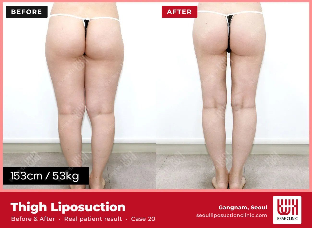 Thigh liposuction before and after, case 20 (photo 1 of 2) – BBAE Clinic, Gangnam Seoul