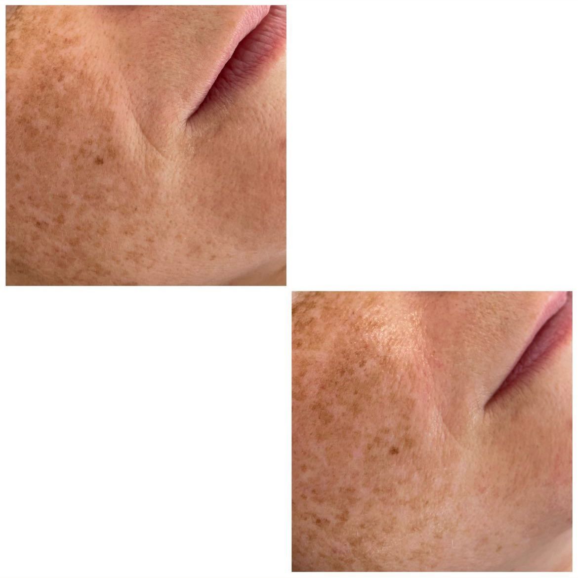 Ein Vorher-Nachher-Bild des Gesichts einer Frau mit Sommersprossen.