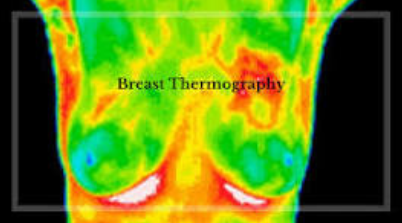 Breast thermography heat map showing a torso with green, yellow, and red color patterns