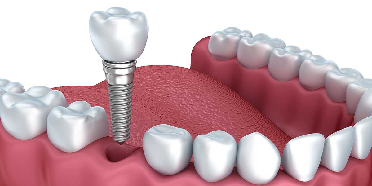 A computer generated image of a dental implant in a person 's mouth.