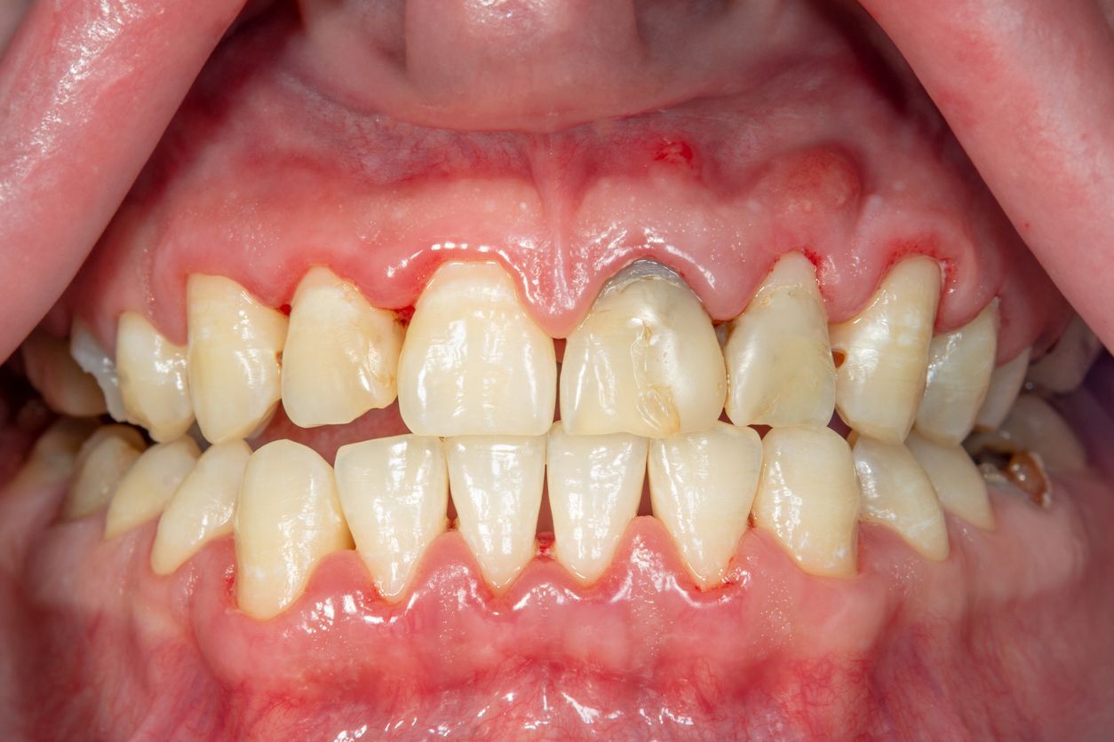 A close up of a person 's teeth with a broken tooth.