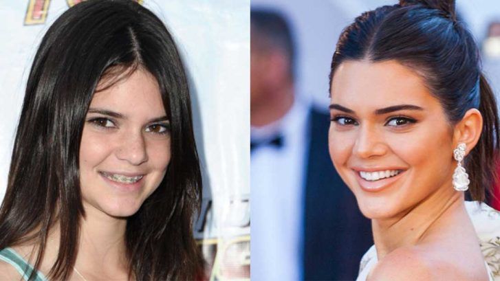 A young girl with braces on her teeth and a young woman with braces on her teeth.