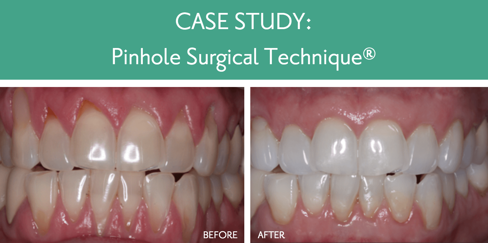 A picture of a person 's teeth before and after a pinhole surgical technique