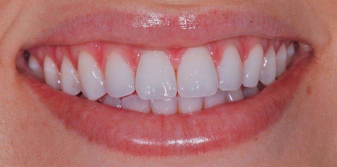 A close up of a woman 's smile with white teeth.