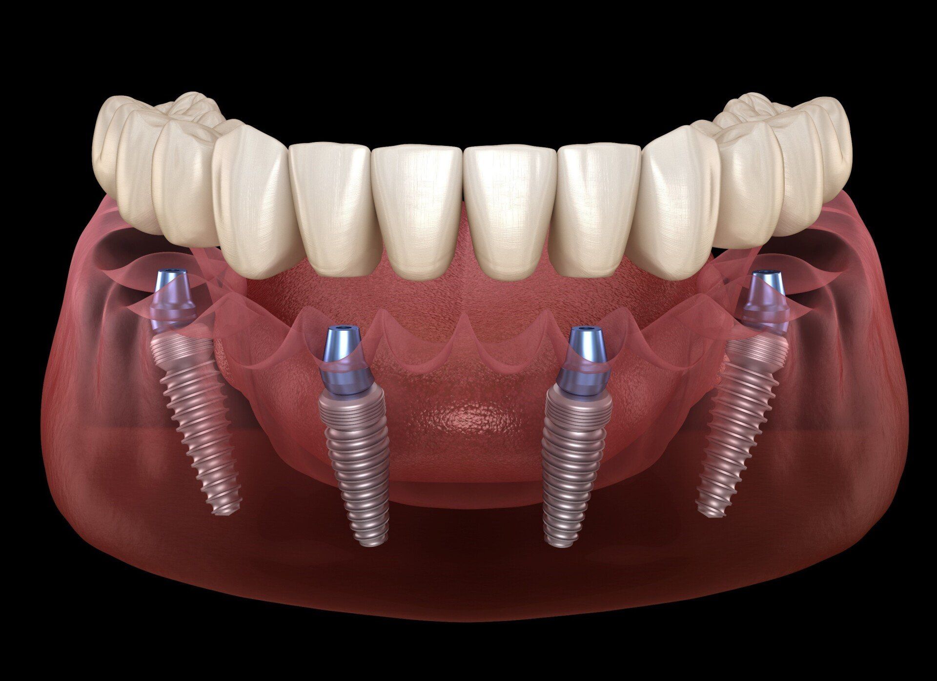 A computer generated image of a full denture with four dental implants.