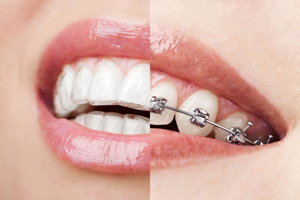 A close up of a woman 's teeth with braces and without braces.