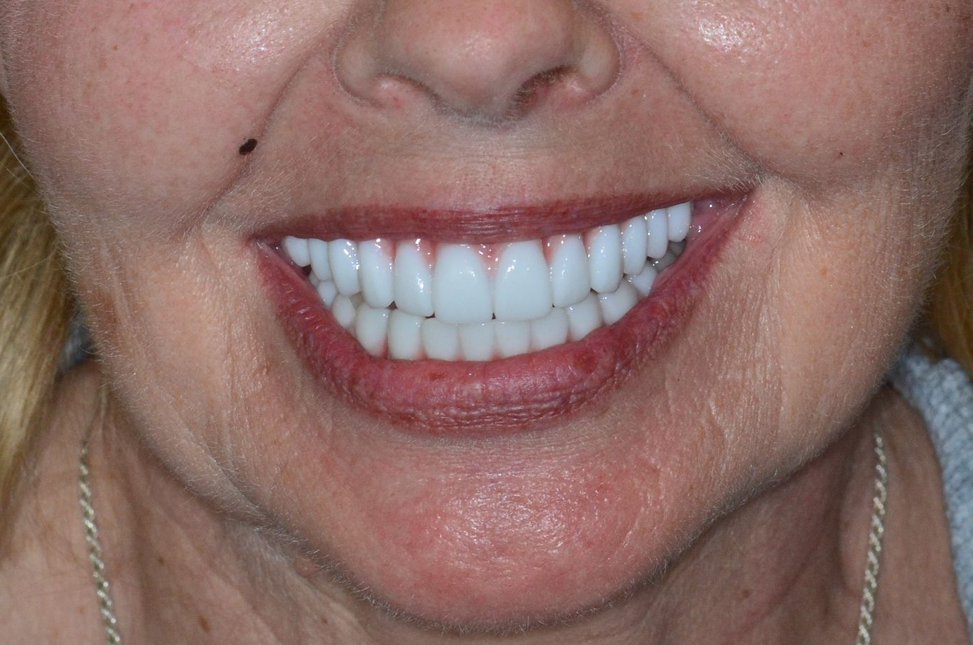 A woman smiling, showing bright white teeth. Red lipstick on her lips.