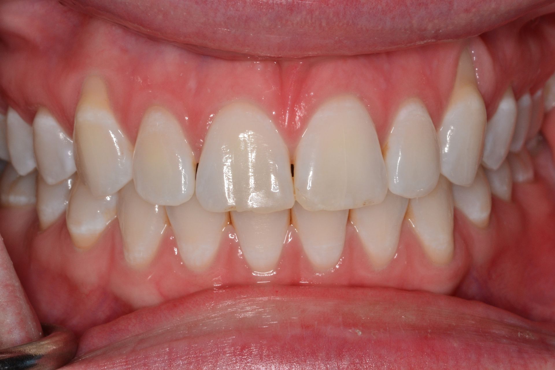 Close-up of a person's upper and lower teeth, showing a healthy smile with straight, white teeth.