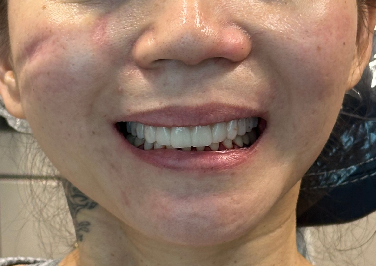 Woman smiling, showing bright white teeth. Redness on cheeks and around the nose, slight shine on face.