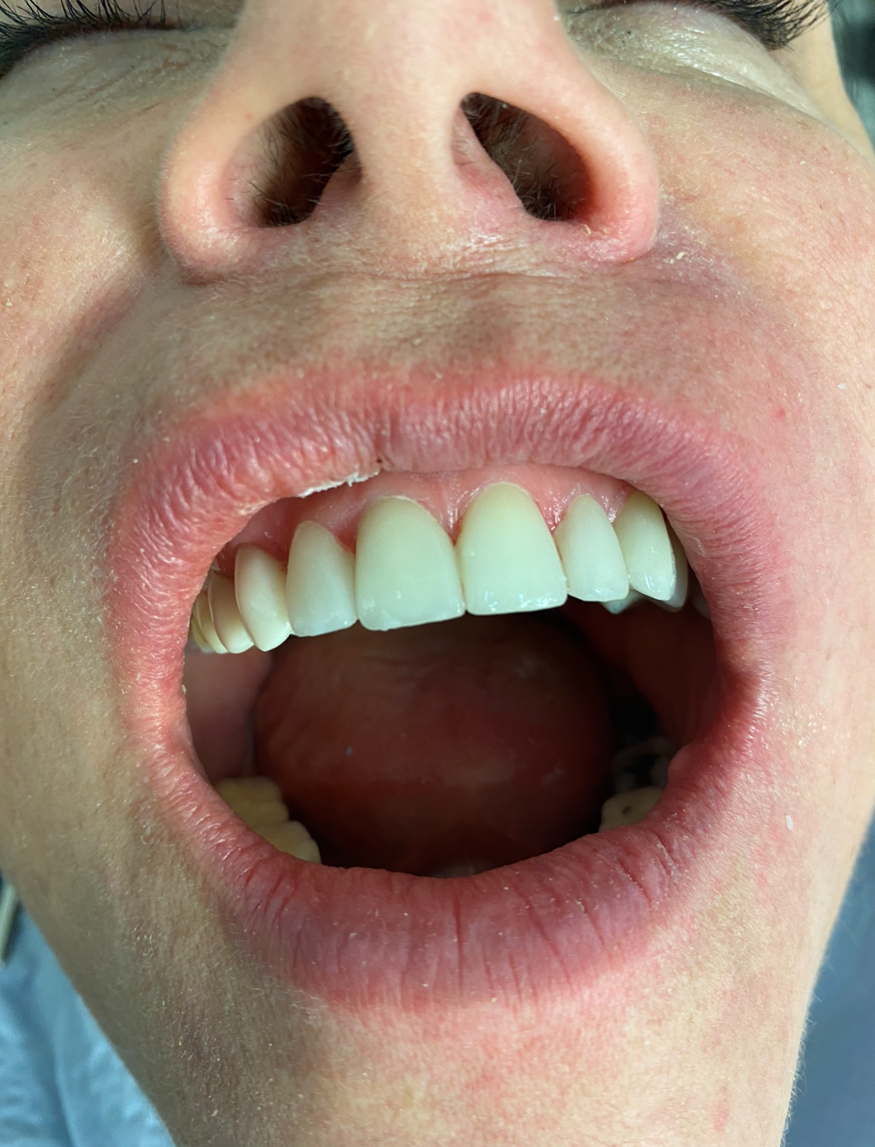 After Image Of Patient 5 — Washington, DC — Michael G. Landy, DDS.