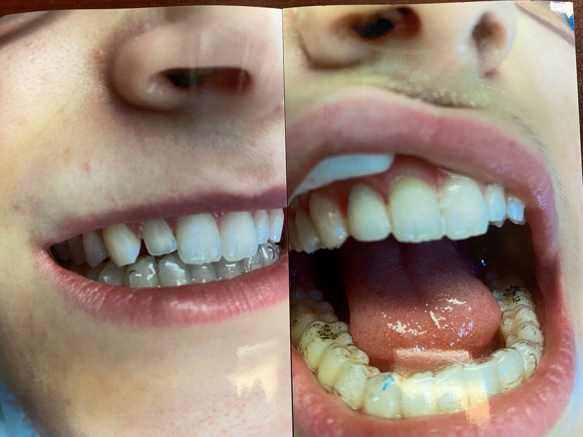 Before Image Of Patient 4— Washington, DC — Michael G. Landy, DDS.