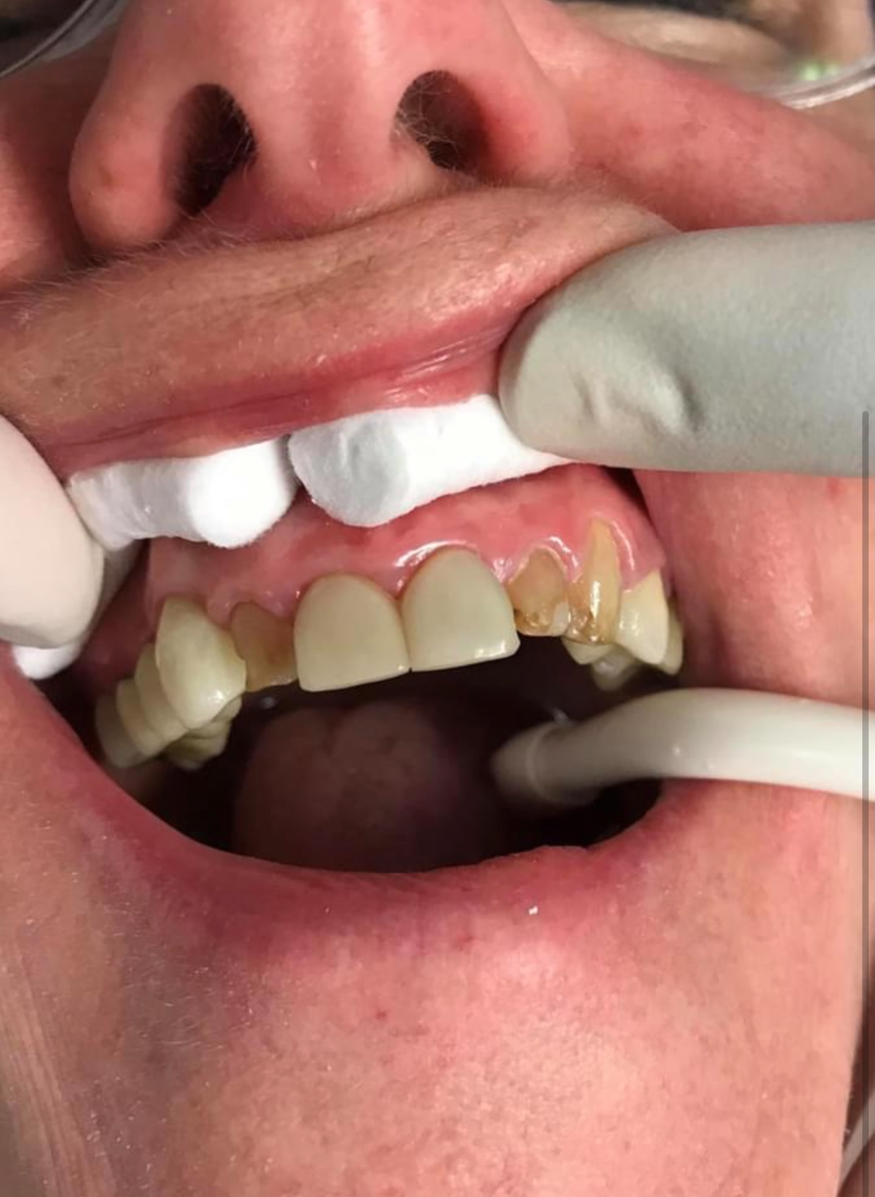Before Image Of Patient 5 — Washington, DC — Michael G. Landy, DDS.