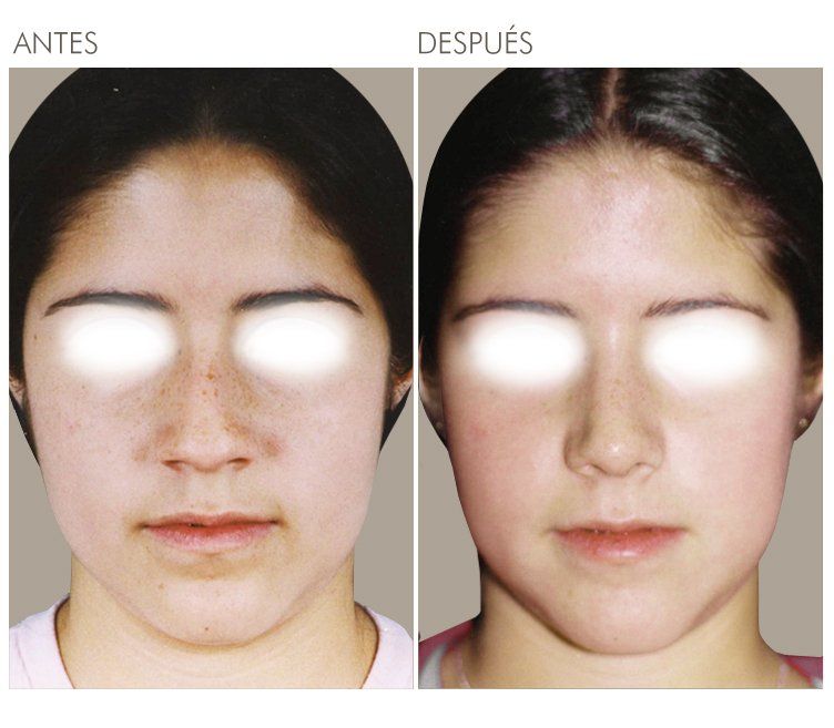 A before and after photo of a woman 's face