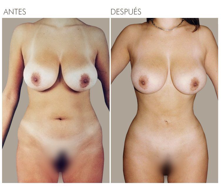 LIPOESCULTURALIPOESCULTURA