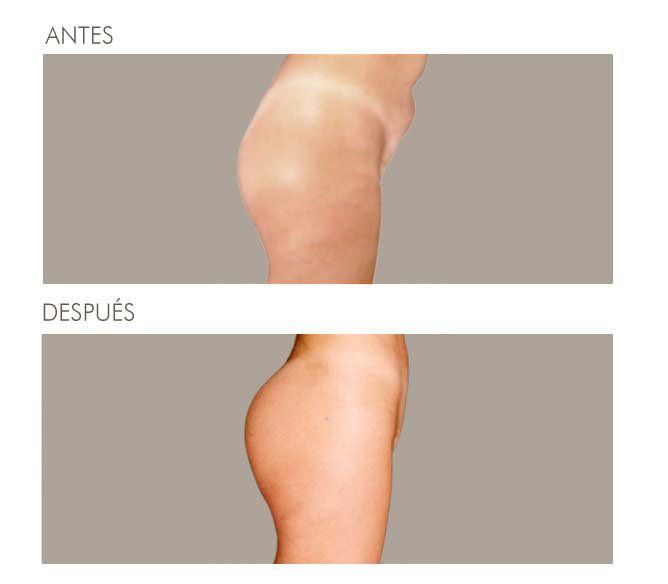 GLUTEOPLASTIA