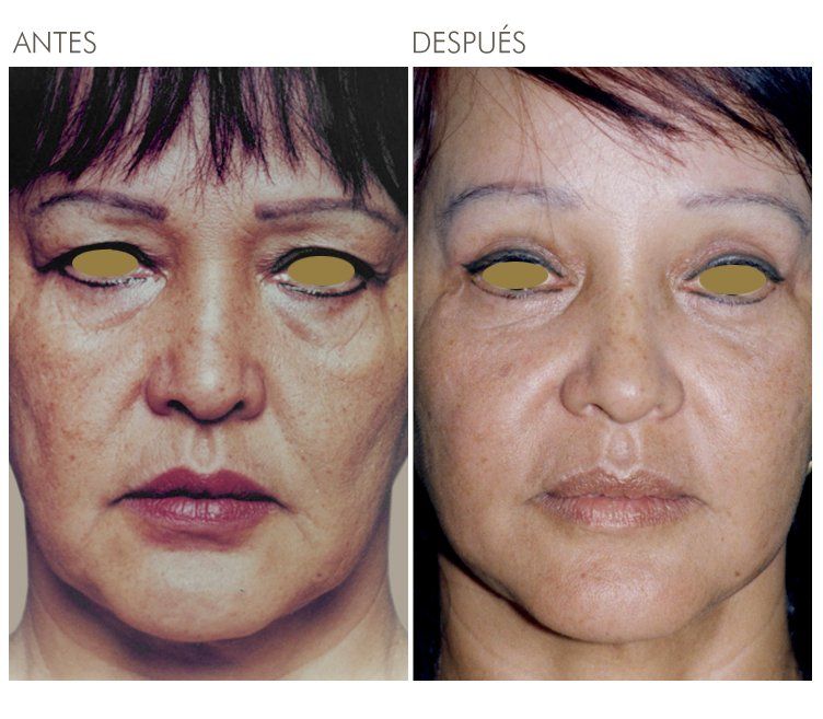 A before and after photo of a woman 's face