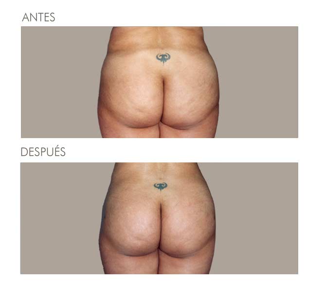 GLUTEOPLASTIA