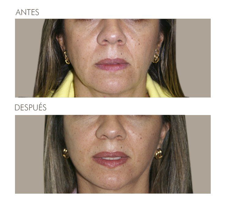 A before and after photo of a woman 's face