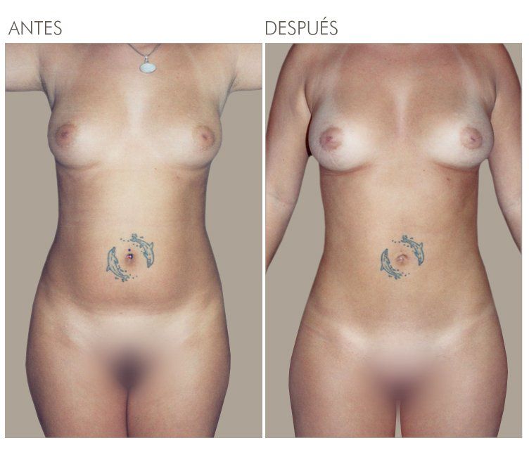LIPOESCULTURA