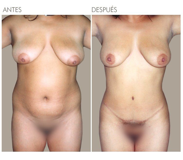 ABDOMINOPLASTIA
