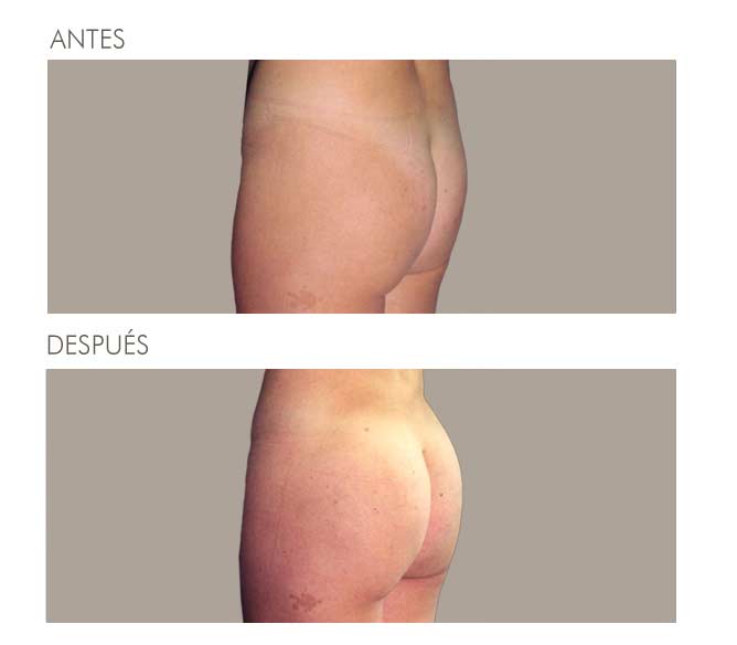 GLUTEOPLASTIA