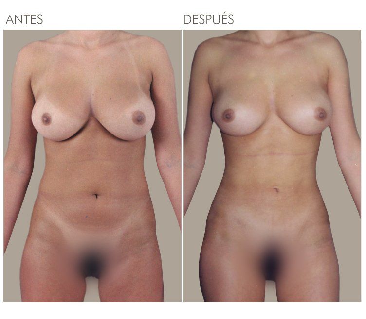 LIPOESCULTURA