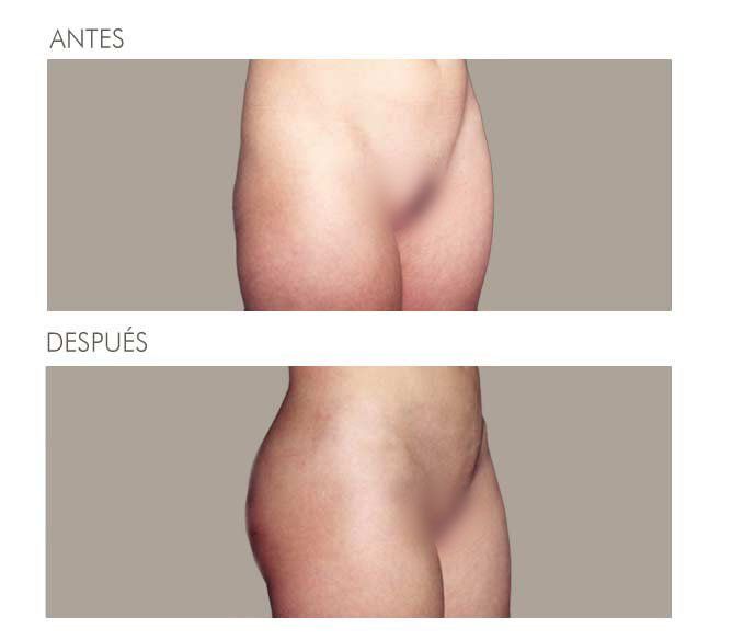 GLUTEOPLASTIA