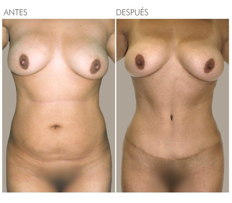 ABDOMINOPLASTIA
