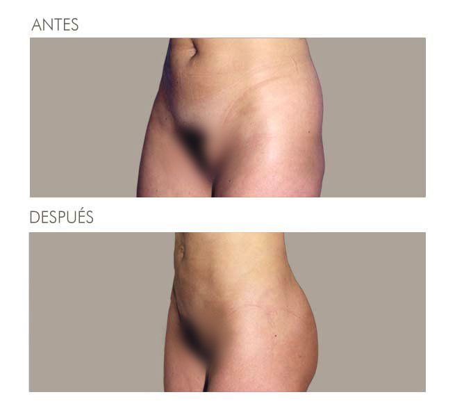 GLUTEOPLASTIA