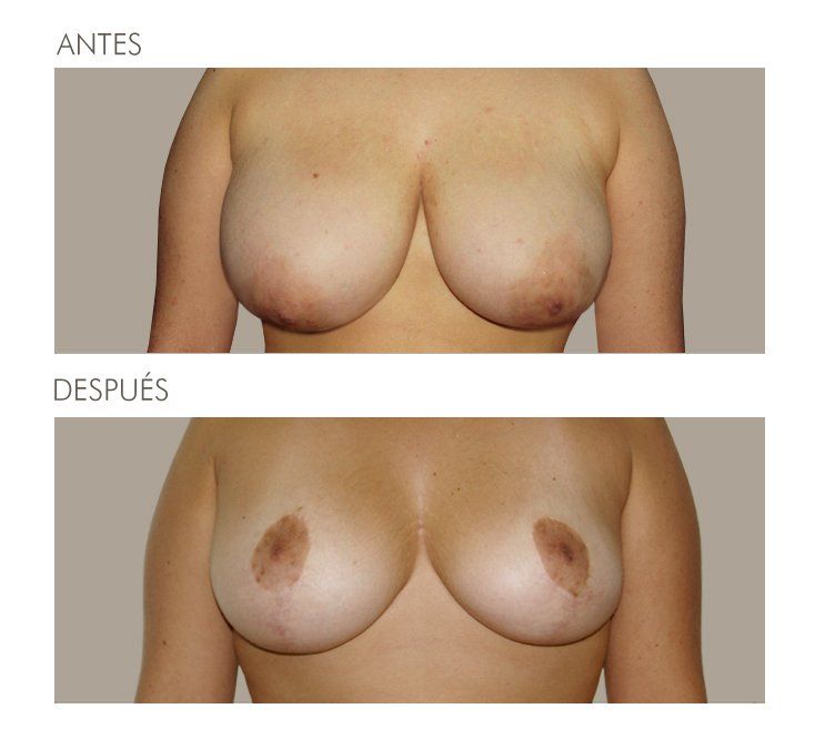 Mastopexia
