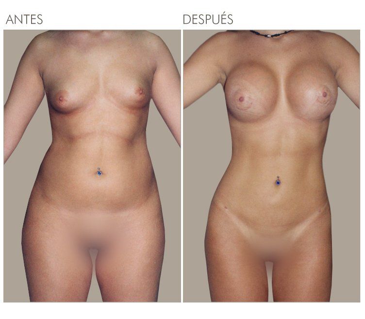 LIPOESCULTURA