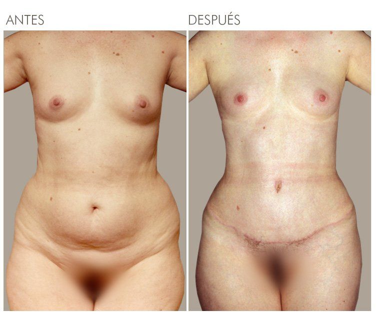 ABDOMINOPLASTIA