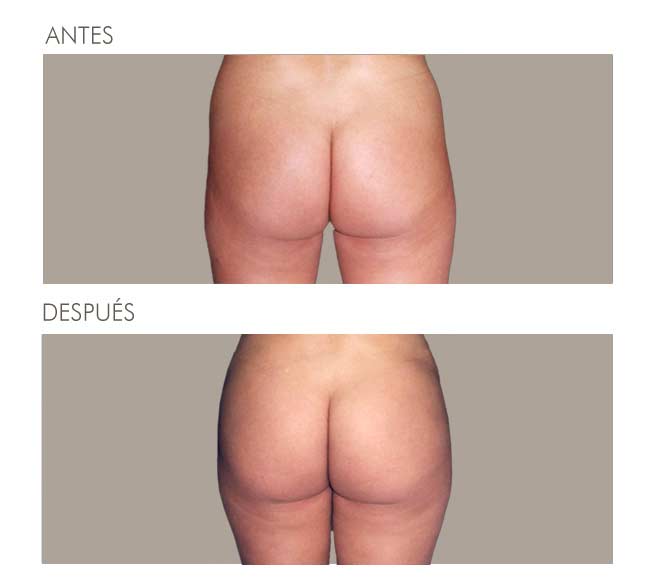 GLUTEOPLASTIA