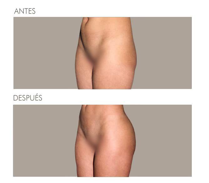 GLUTEOPLASTIA