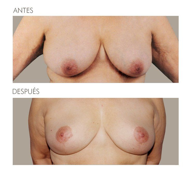 Mastopexia