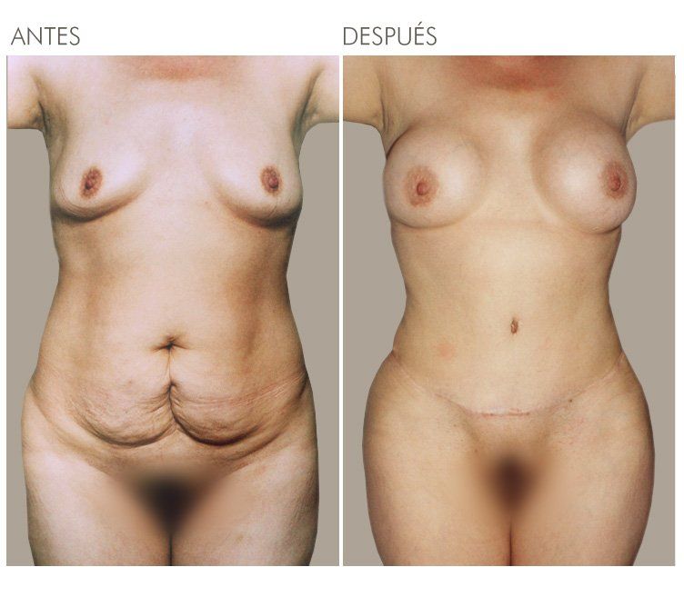 ABDOMINOPLASTIA