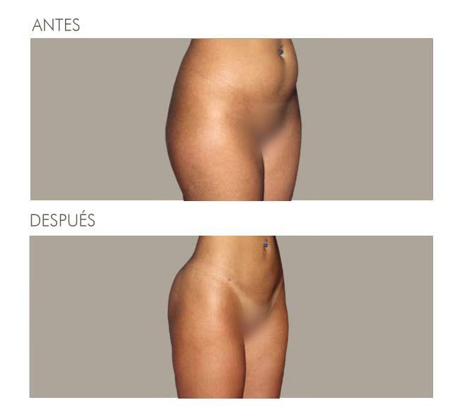 GLUTEOPLASTIA