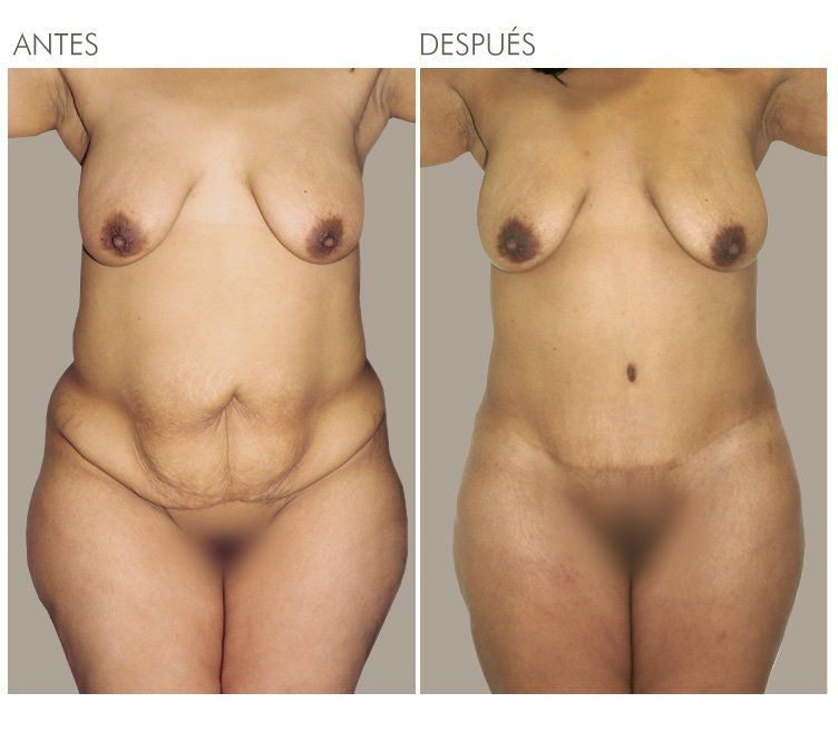 ABDOMINOPLASTIA