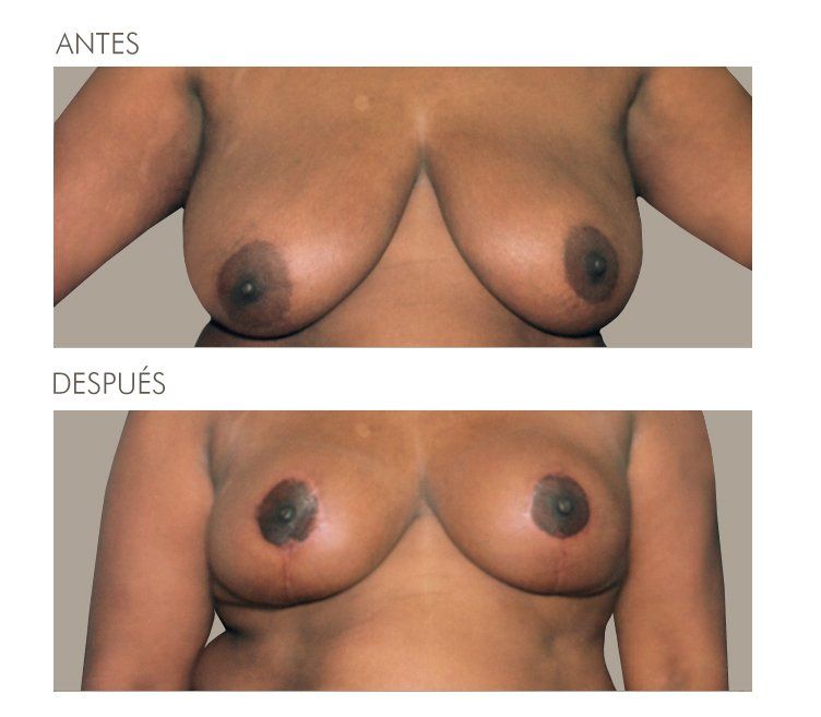 Mastopexia
