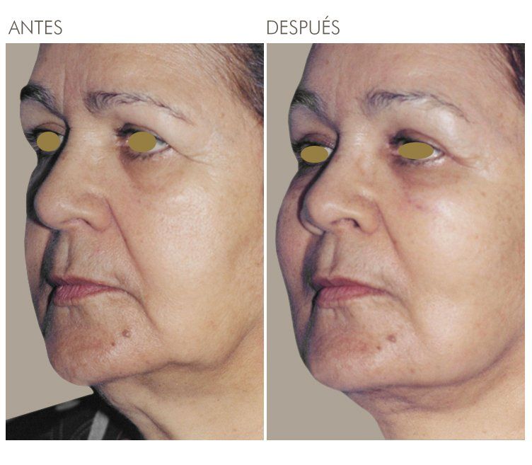 A before and after photo of a woman 's face