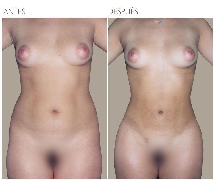 LIPOESCULTURA