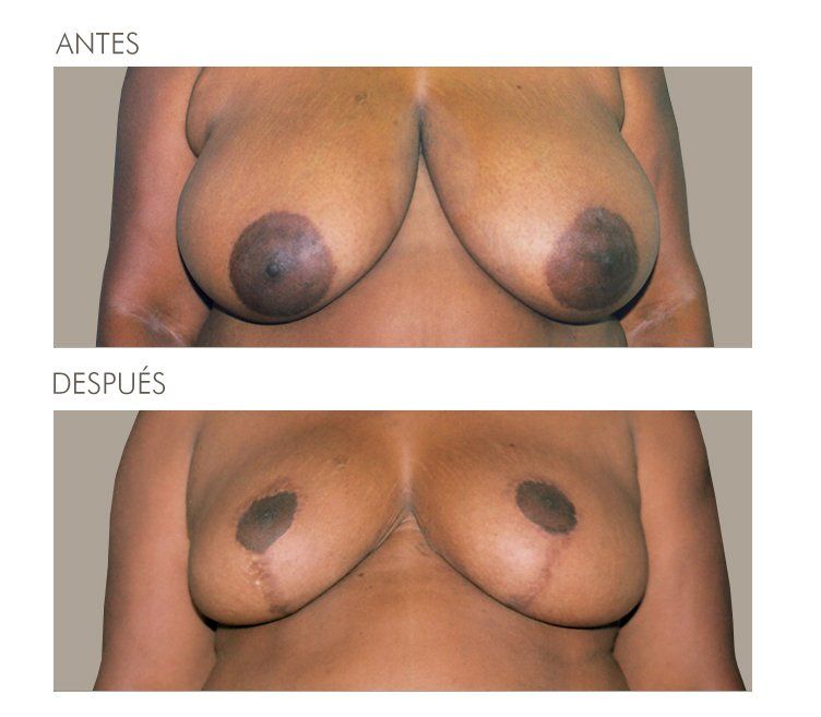 Mastopexia